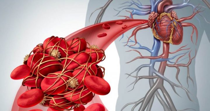 Produtos que provocam a formação de coágulos sanguíneos: TOP-3 de especialistas